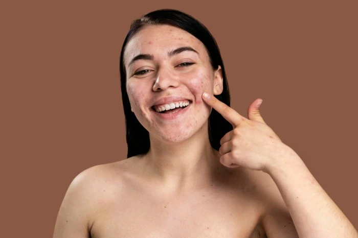 Acne Prevention