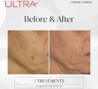 LaseMD Ultra laser facial results near Cumming, GA — WMG MedSpa