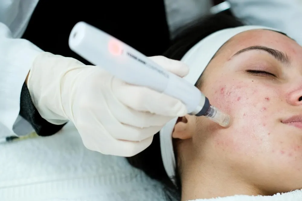 Genius RF Microneedling