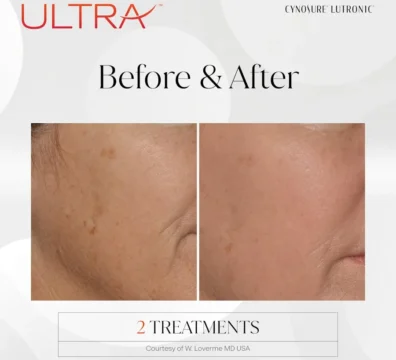 Laser facial before and after — WMG MedSpa Cumming GA