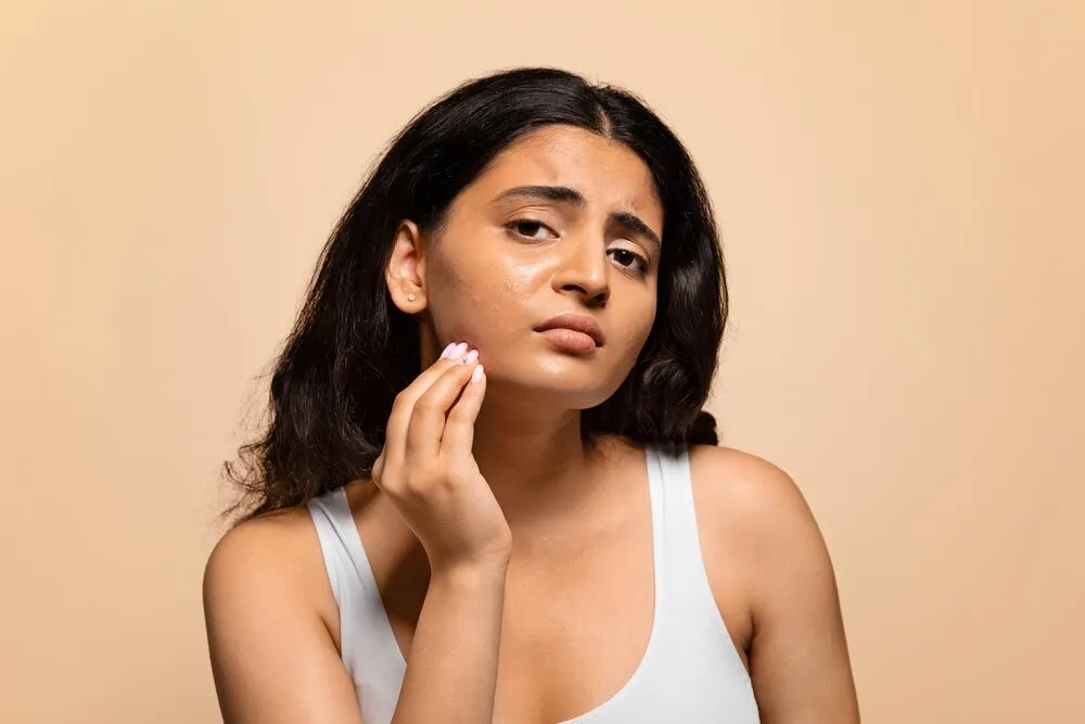 Acne reduction