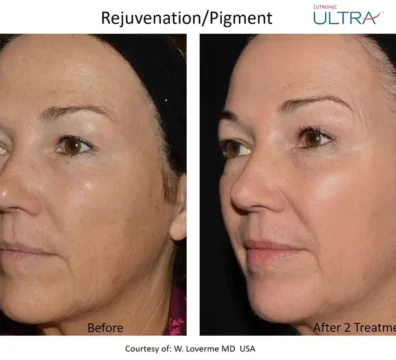 rf treatment near me