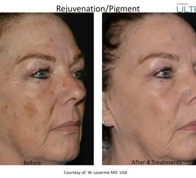 laser scar removal