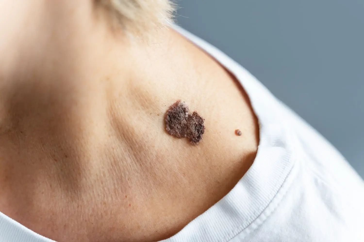 Pigmented Lesion Treatment
