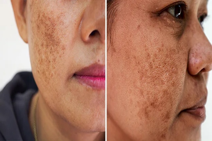 Melasma vs Hyperpigmentation