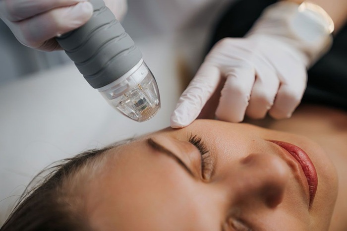 RF Microneedling Benefits