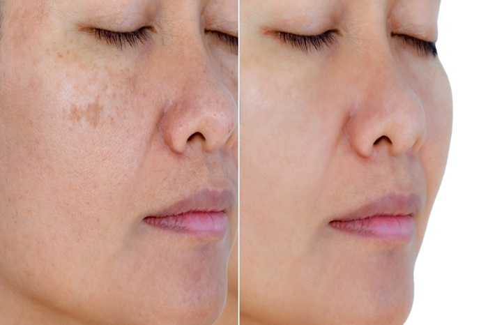 Laser Treatment for Sun Spots