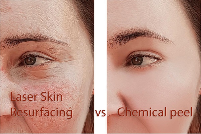 Chemical Peel vs Laser Resurfacing