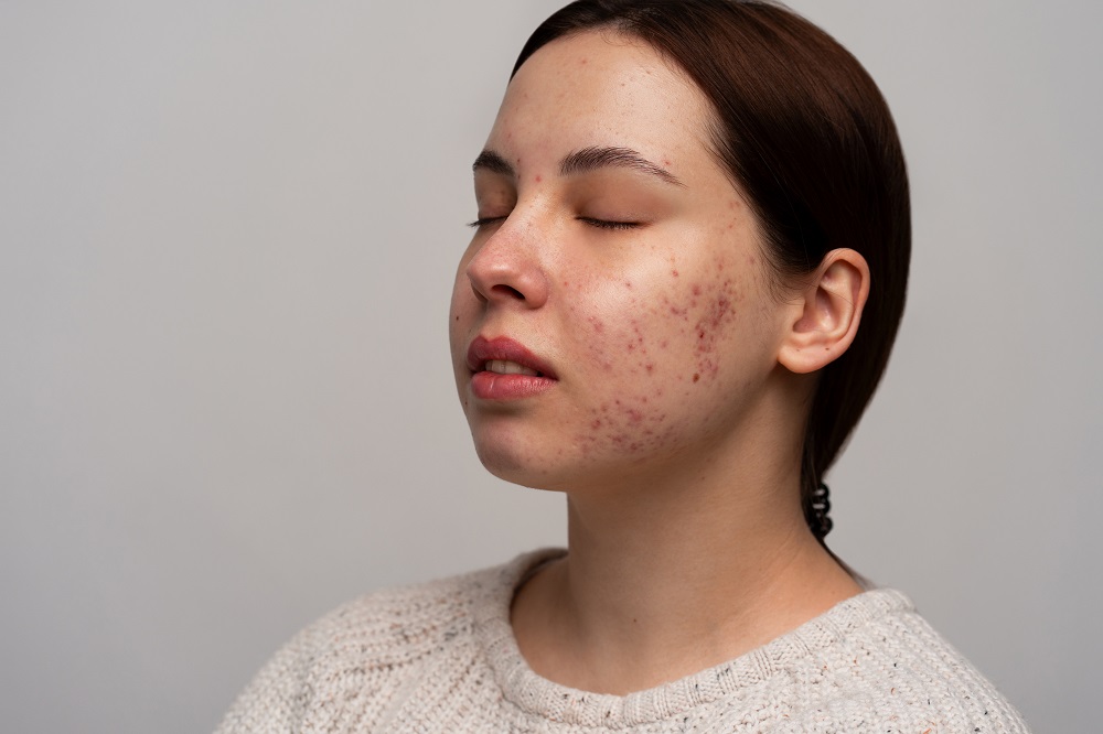 Acne Scars & Large Pores