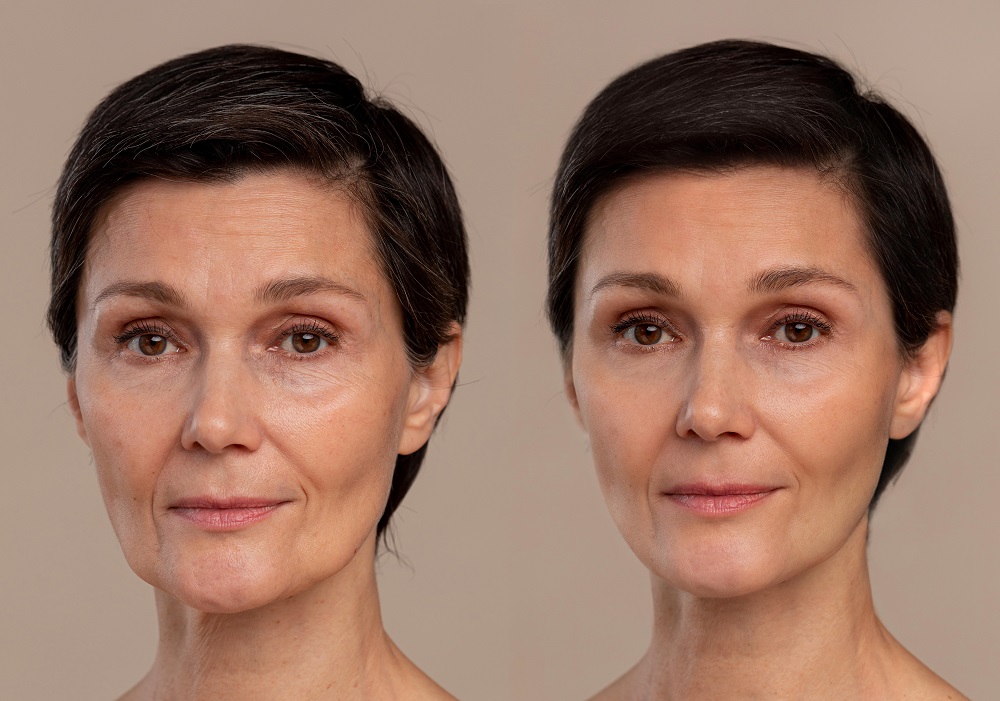 Anti-Aging Results