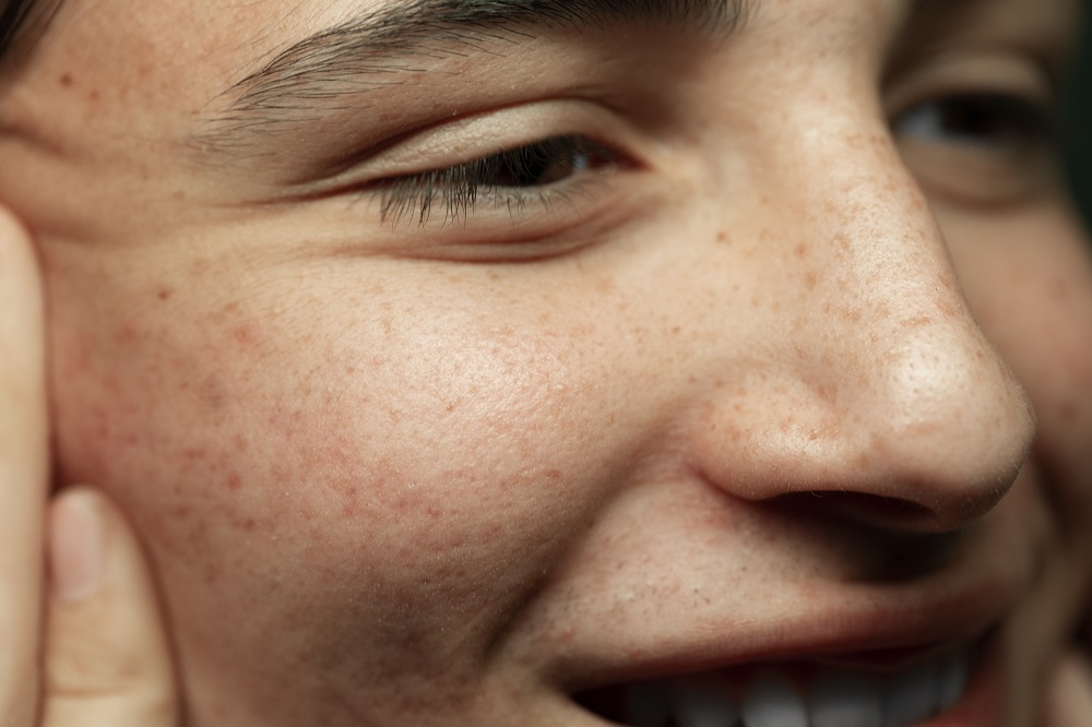 Large Pores: