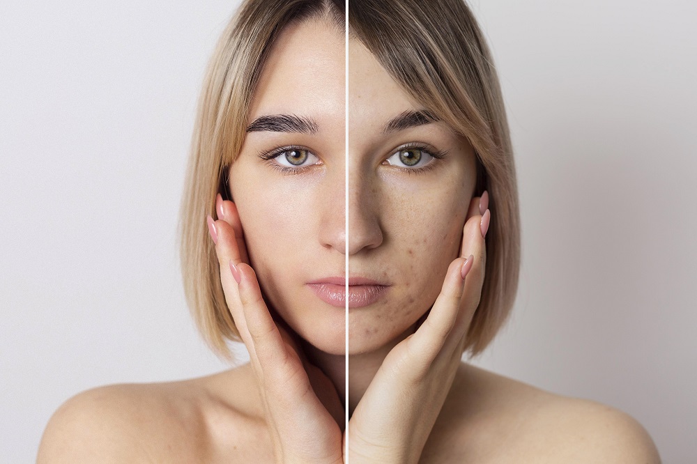 Melasma Treatment