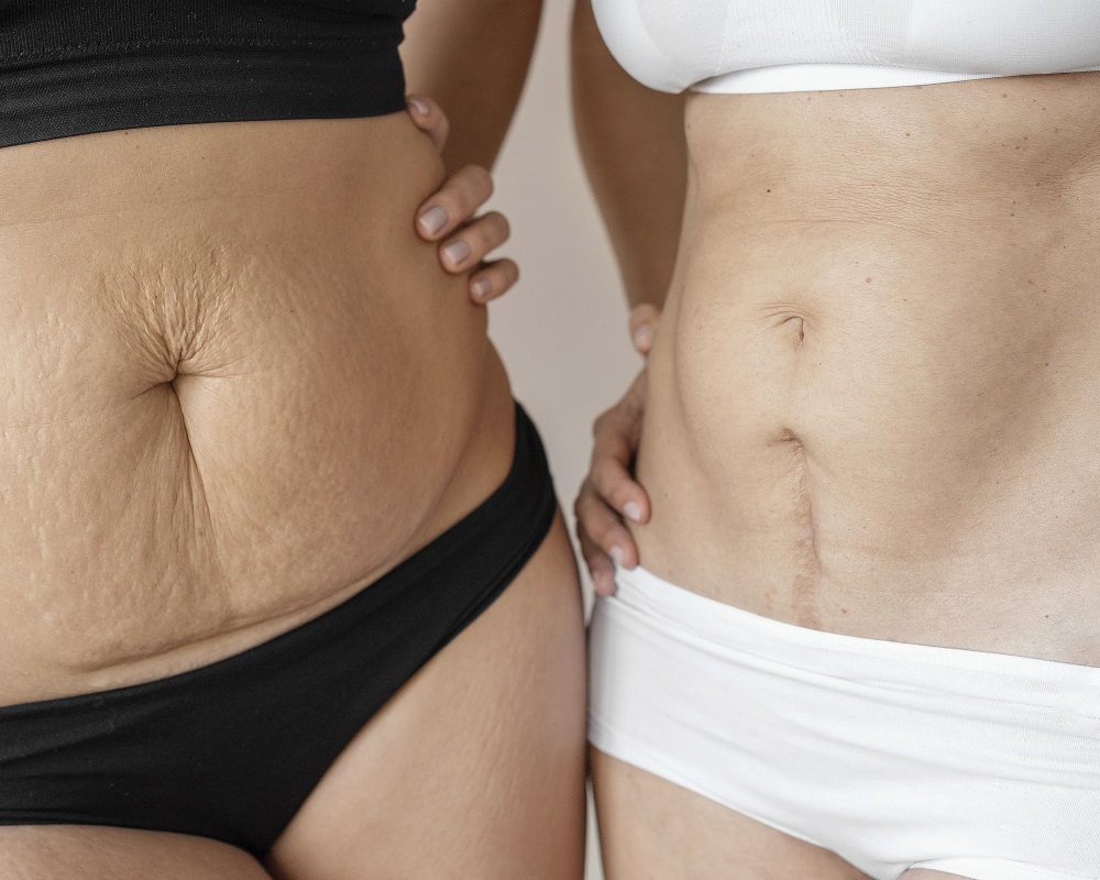 How to Get Rid of Stretch Marks