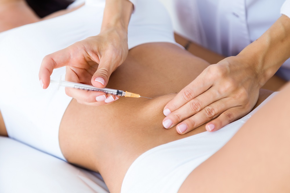 RF Microneedling for Stretch Marks